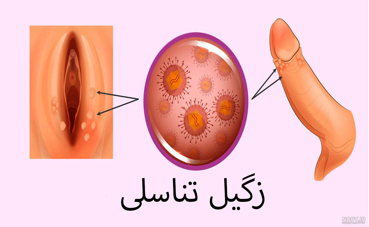 عکس انواع زگیل تناسلی در مردان
