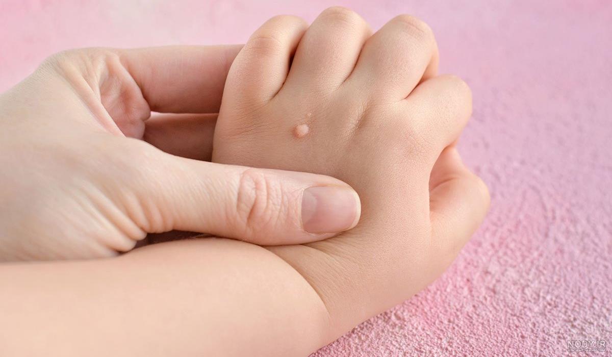 عکس انواع زگیل دهانی
