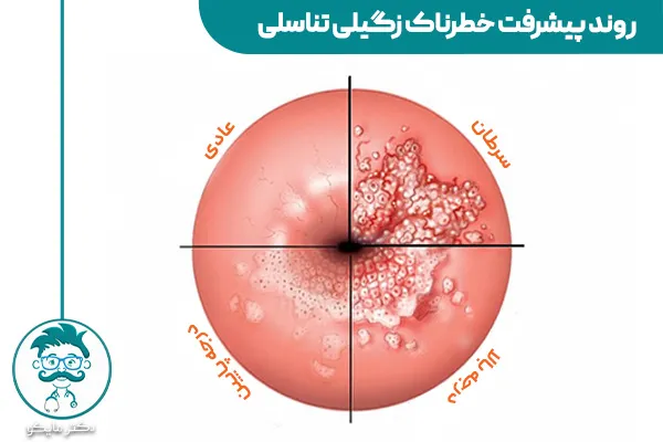 عکس زگیل تناسلی (تصاویر واضح زگیل در زنان و مردان) - ایران کلینیک عکس زگیل تناسلی (تصاویر واضح زگیل در زنان و مردان) - ایران کلینیک