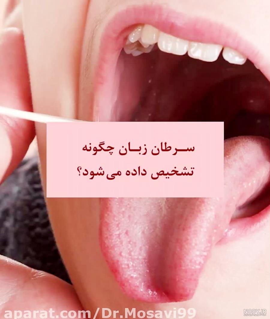 آفت دهان عکس زبان سرطانی آفت دهان عکس زبان سرطانی