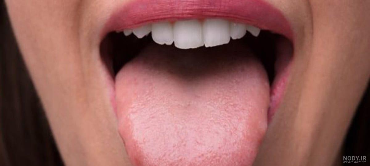 بعد از جراحی سرطان زبان بعد از جراحی سرطان زبان