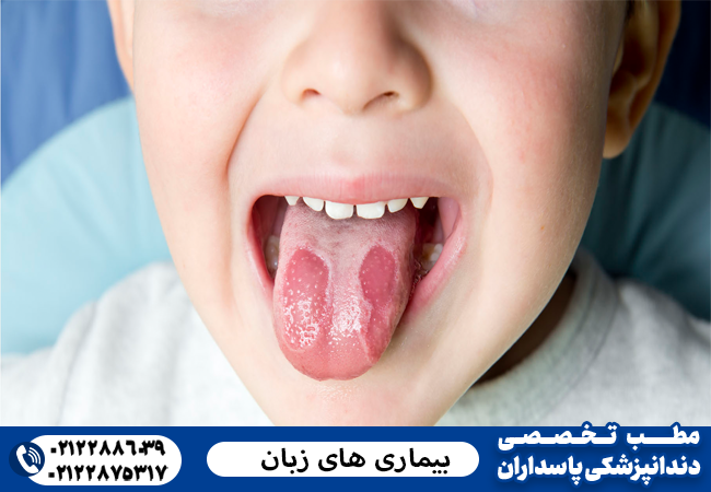 بیماری عکس زبان سرطانی بیماری عکس زبان سرطانی