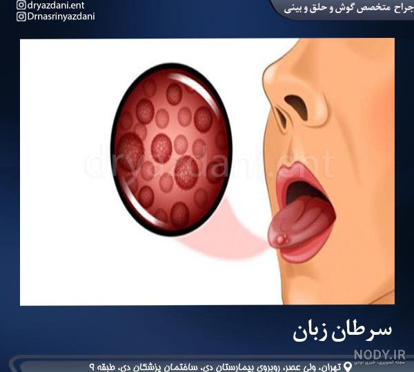 درمان جوش روی زبان؛ علائم، دلایل و روش درمان زخم روی زبان - کیوت مگ | CuteSkin درمان جوش روی زبان؛ علائم، دلایل و روش درمان زخم روی زبان - کیوت مگ | CuteSkin