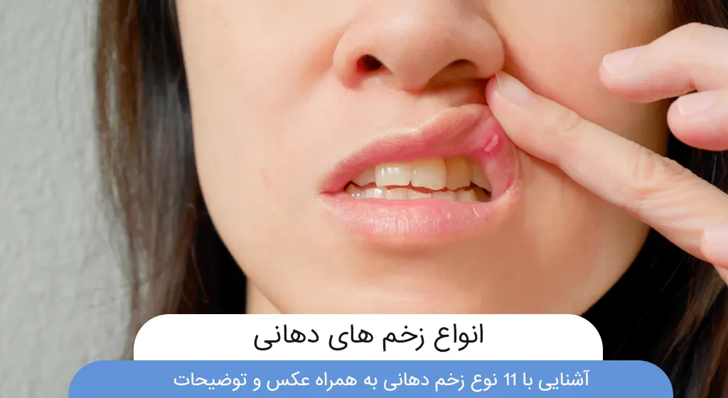 درمان زگیل دهانی و زبان با لیزر درمان زگیل دهانی و زبان با لیزر