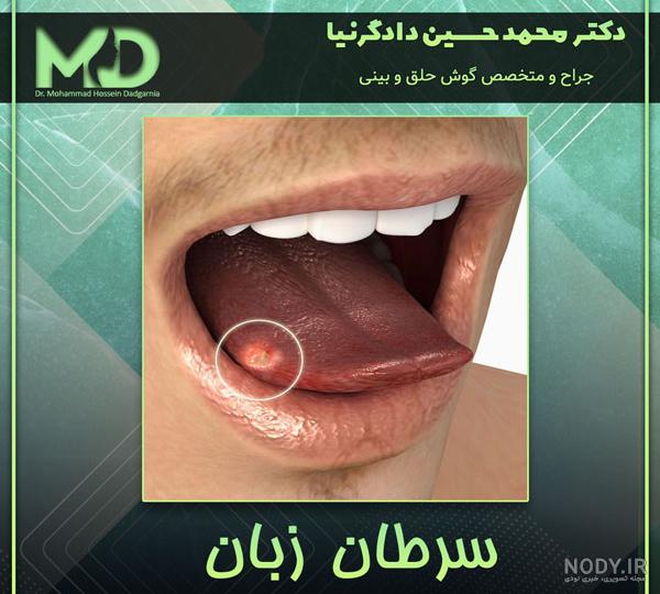 سرطان زبان | بیماری های زبان | متخصص گوش و حلق و بینی | دکتر مریم یعقوبی سرطان زبان | بیماری های زبان | متخصص گوش و حلق و بینی | دکتر مریم یعقوبی