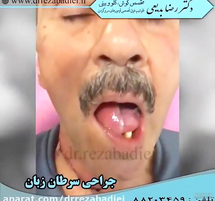 سرطان زبان: یک بیماری جدی اما قابل درمان - دکترنکست سرطان زبان: یک بیماری جدی اما قابل درمان - دکترنکست