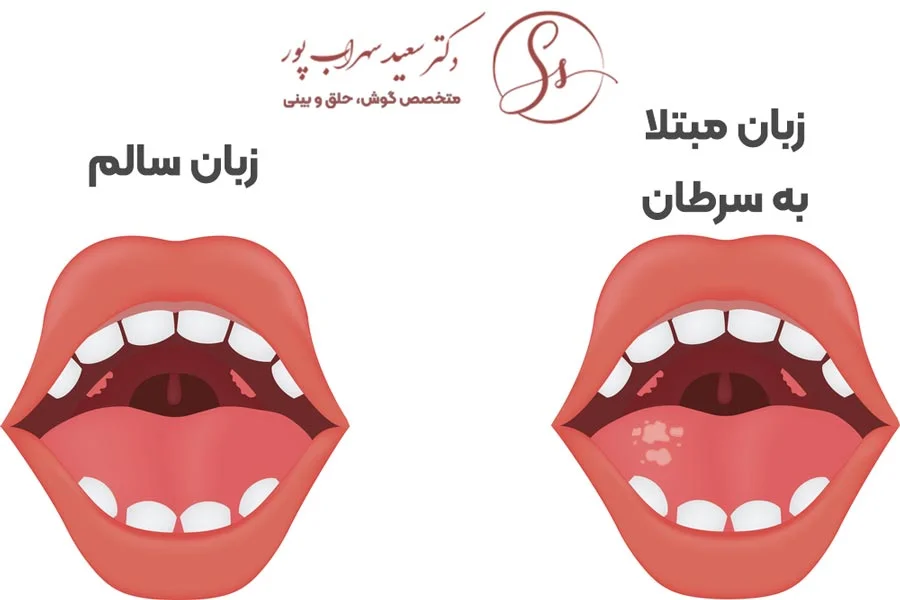 سرطان زبان، علائم، تشخیص و درمان آن (بخش اول) سرطان زبان، علائم، تشخیص و درمان آن (بخش اول)