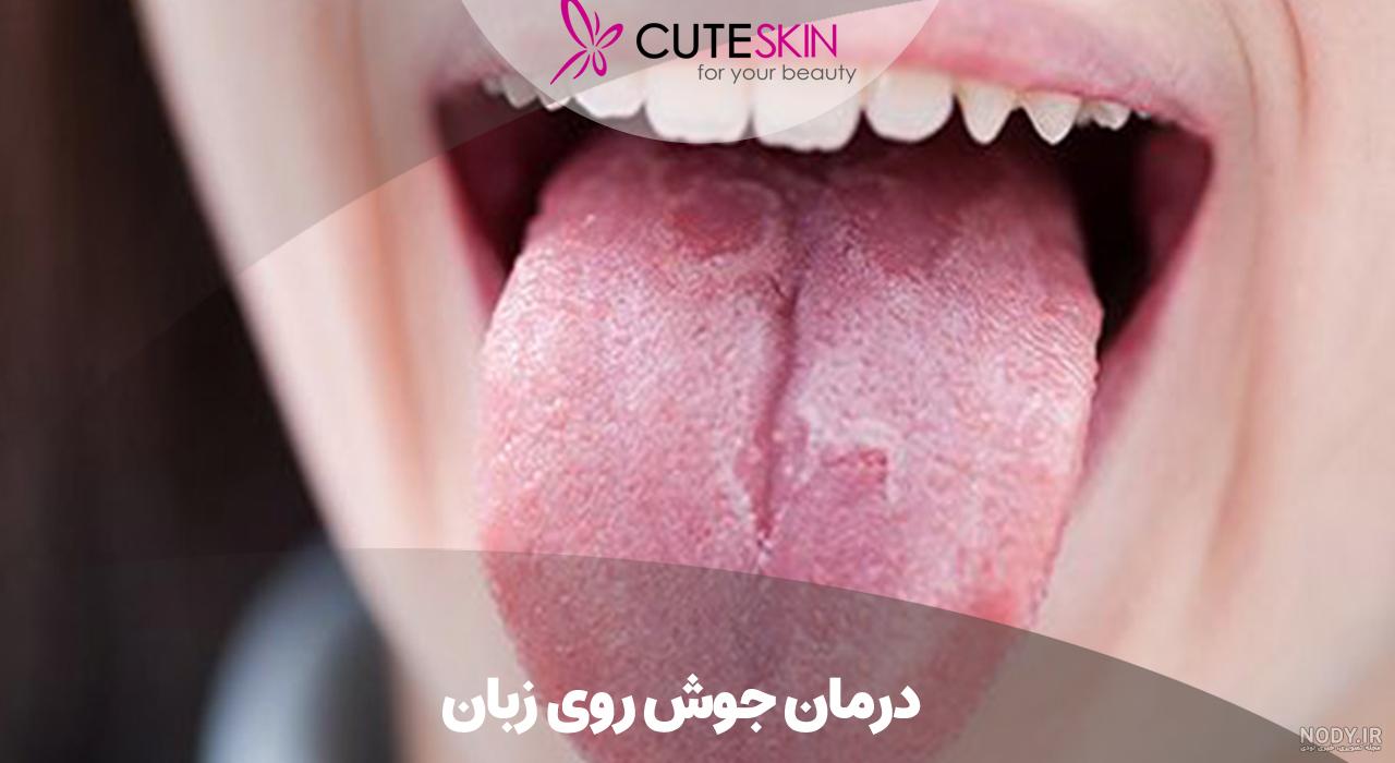 علائم سرطان زبان علائم سرطان زبان