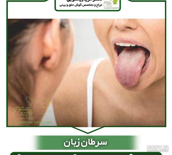عکس از زبان سرطانی عکس از زبان سرطانی