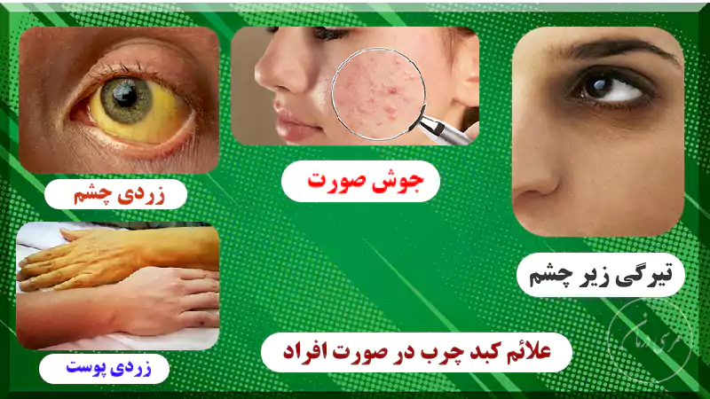 عکس جوش های کبد چرب