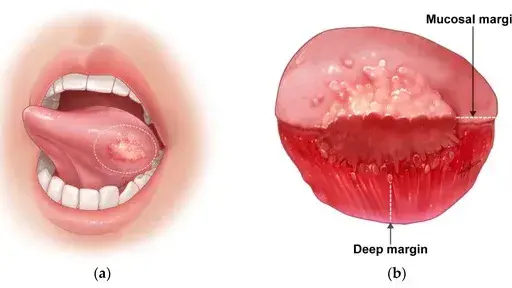 عکس سرطان دهان و زبان - دکتر امید امیربنده متخصص جراحی لثه و ایمپلنت عکس سرطان دهان و زبان - دکتر امید امیربنده متخصص جراحی لثه و ایمپلنت