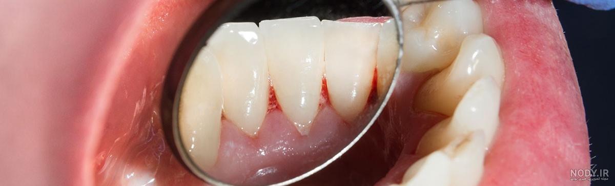 13نشانه سرطان زبان💉]+[تشخیص و مراحل درمان 💊] آسان تست