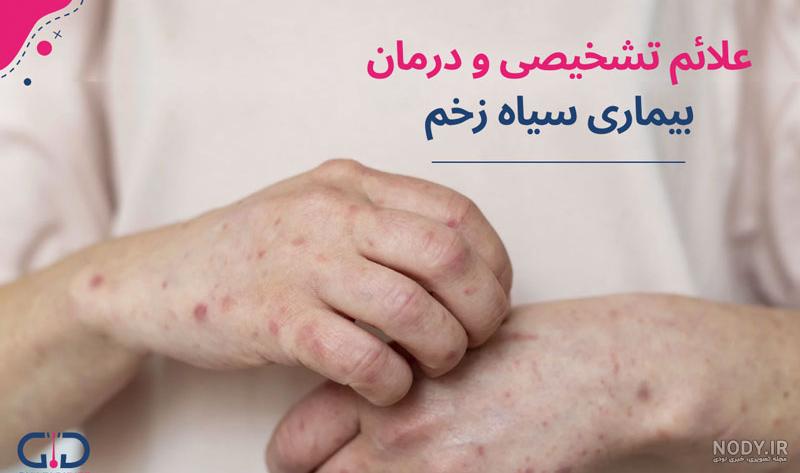 آنتراکس پلک (سیاه زخم) چیست و چرا نیاز به درمان فوری دارد؟ - پروفسور محمد  طاهر رجبی