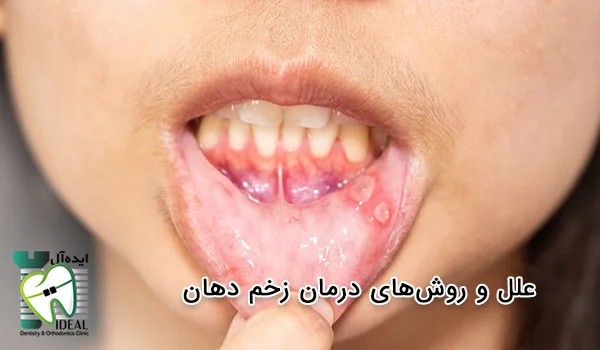 سیاه زخم (Anthrax): دلایل، علائم و نشانه ها، راه های تشخیص و درمان