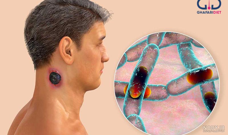 سیاه زخم یا آنتراکس چیست؟و انواع سیاه زخم کدامها هستند؟ - کلینیک زخم اهواز