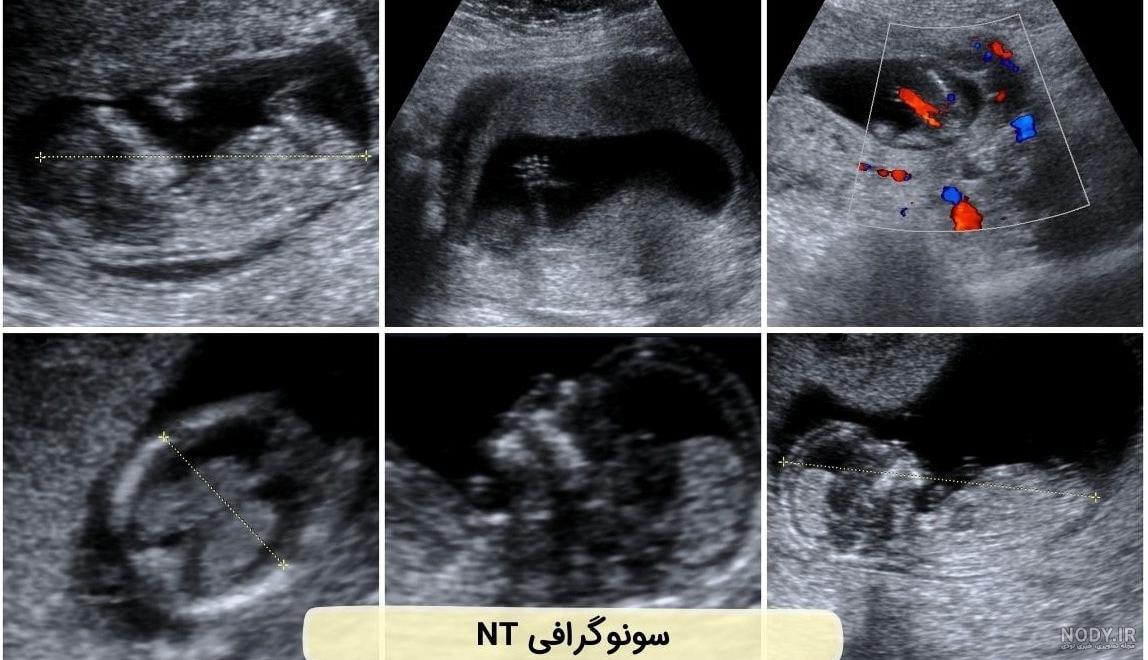 عکس جنین یک ماهه در سونوگرافی عکس جنین یک ماهه در سونوگرافی