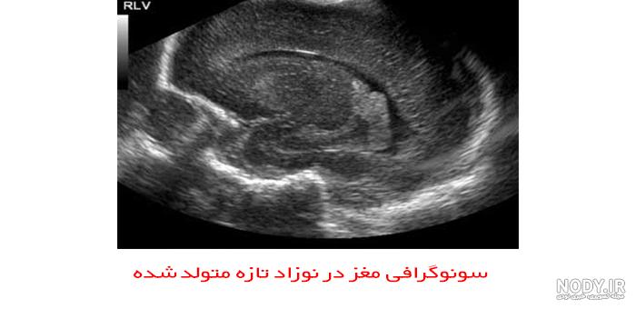 عکس سونوگرافی جنین پسر - مرکز تصویربرداری دکتر شاکری عکس سونوگرافی جنین پسر - مرکز تصویربرداری دکتر شاکری