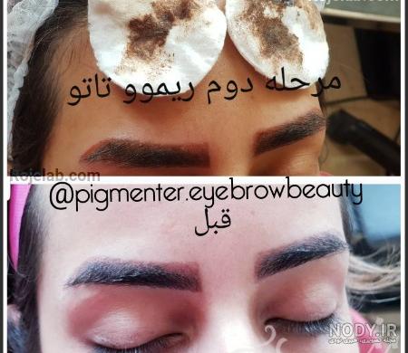 اسکین سازی تاتو چیست؟ | مهسا جلیلی اسکین سازی تاتو چیست؟ | مهسا جلیلی