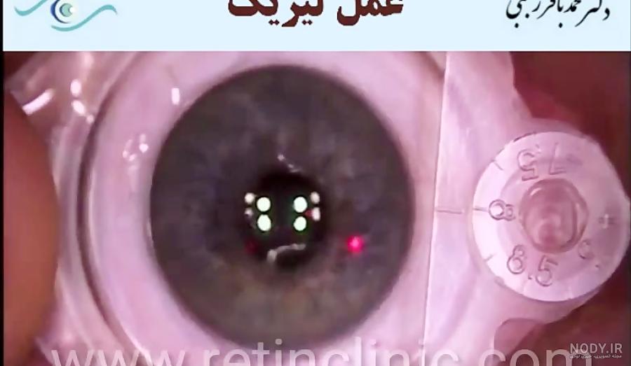 دستگاه لیزر اگزایمر | قیمت دستگاه لیزیک چشم | ویتیلیگو teneo - سینا طب دستگاه لیزر اگزایمر | قیمت دستگاه لیزیک چشم | ویتیلیگو teneo - سینا طب
