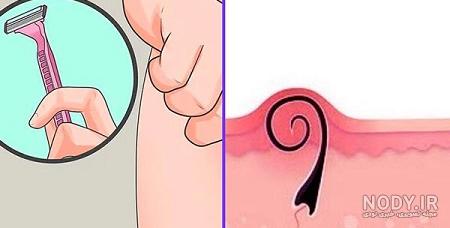 عکس جوش ناحیه تناسلی زن