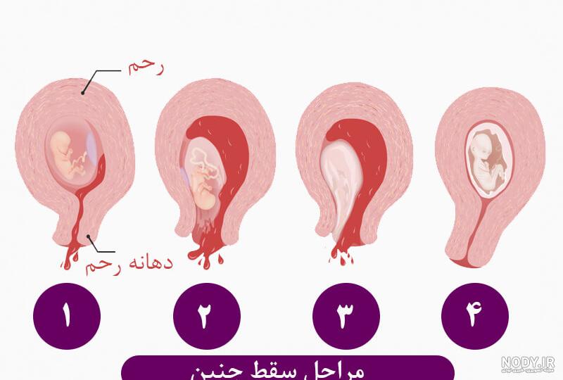 فرق قاعدگی با سقط جنین و از کجا بدونم پریودم سنگینه یا سقط کردم؟ | نی نی پلاس فرق قاعدگی با سقط جنین و از کجا بدونم پریودم سنگینه یا سقط کردم؟ | نی نی پلاس