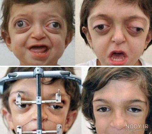 معاینه چشم کوچکترین مرد دنیا توسط هاشمی/نوبت دندانپزشکی بعد از 5 سال - تسنیم