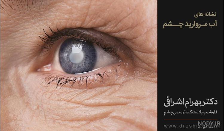 آب مروارید (کاتاراکت): علت، علائم، درمان، هزینه - دکتر سعید یادگاری