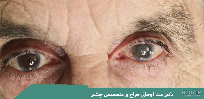 آب مروارید (کاتاراکت) - مرکز چشم پزشکی سلامت غرب تهران