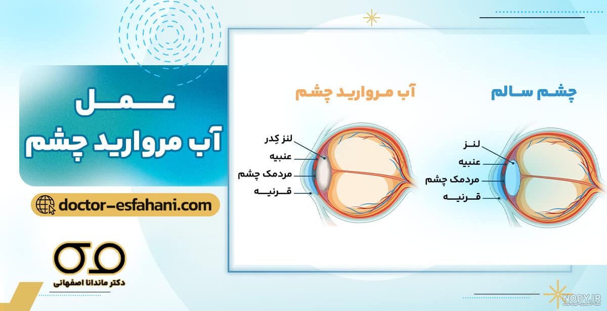آب مروارید (کاتاراکت) چیست، انواع مختلف و درمان آنها - کلینیک جوان