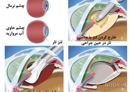 آب مروارید - کلینیک چشم پزشکی ایرانیان آب مروارید - کلینیک چشم پزشکی ایرانیان
