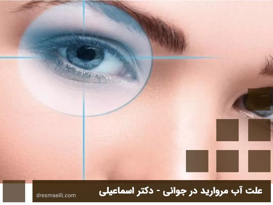 آشنایی با آب مروارید (کاتاراکت) و تاثیرات آن بر بینایی | درمان آب مروارید |  دکتر مریم روشنی