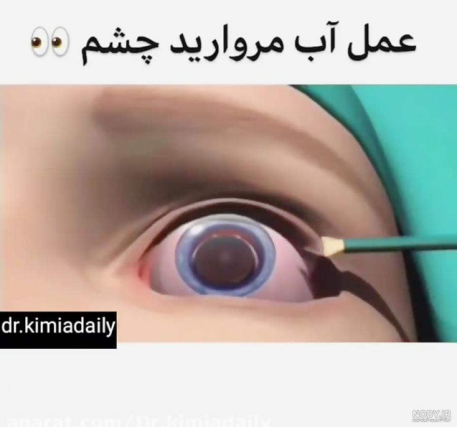 از کجا بفهمیم آب مروارید داریم؟ + علائم و درمان انواع آب مروارید