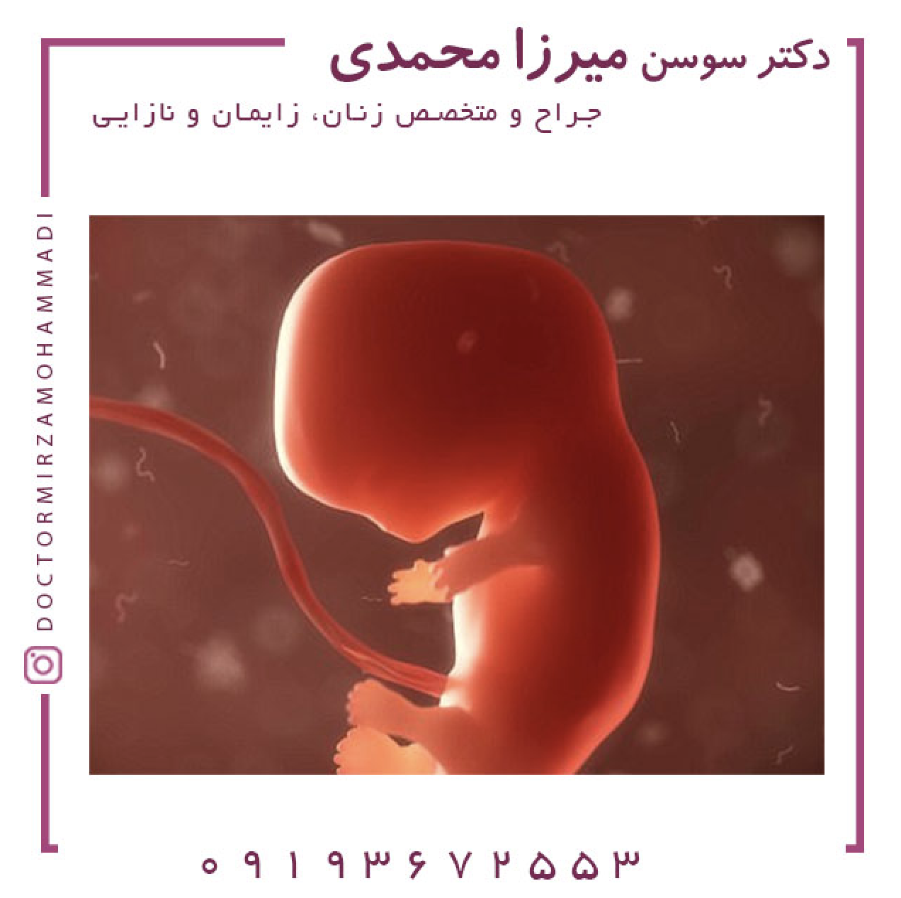 انواع سقط جنین را بشناسید