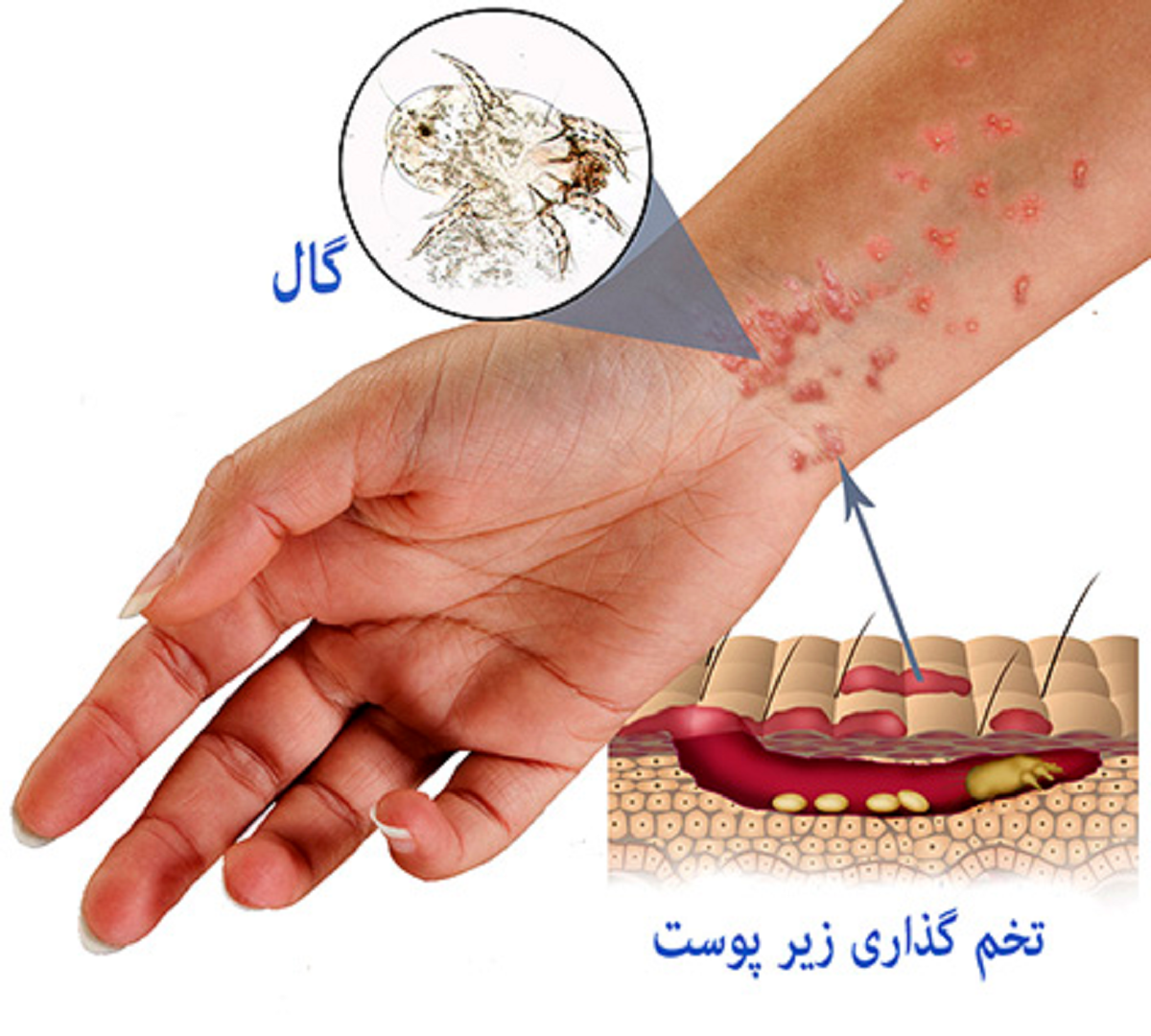 تصاویر بیماری گال درمان - عکس نودی تصاویر بیماری گال درمان - عکس نودی