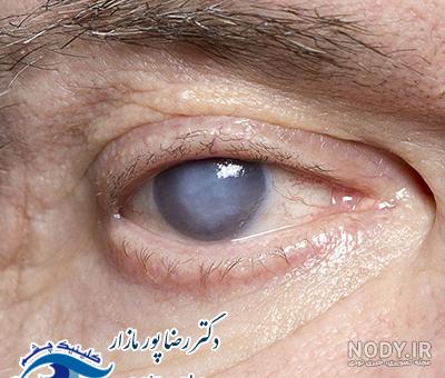جراحی آب مروارید | دکتر گلدیس اسپندار|چشم پزشک|فوق تخصص قرنیه|فاطمی|گیشا|امیرآباد جراحی آب مروارید | دکتر گلدیس اسپندار|چشم پزشک|فوق تخصص قرنیه|فاطمی|گیشا|امیرآباد
