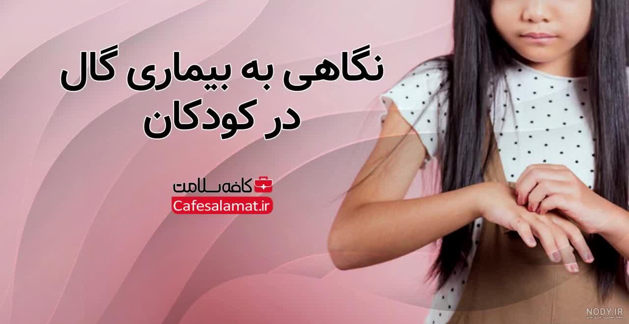 راه درمان گال پوستی - هر آنچه باید در مورد بیماری پوستی گال بدانید | دکتر انتظاری راه درمان گال پوستی - هر آنچه باید در مورد بیماری پوستی گال بدانید | دکتر انتظاری