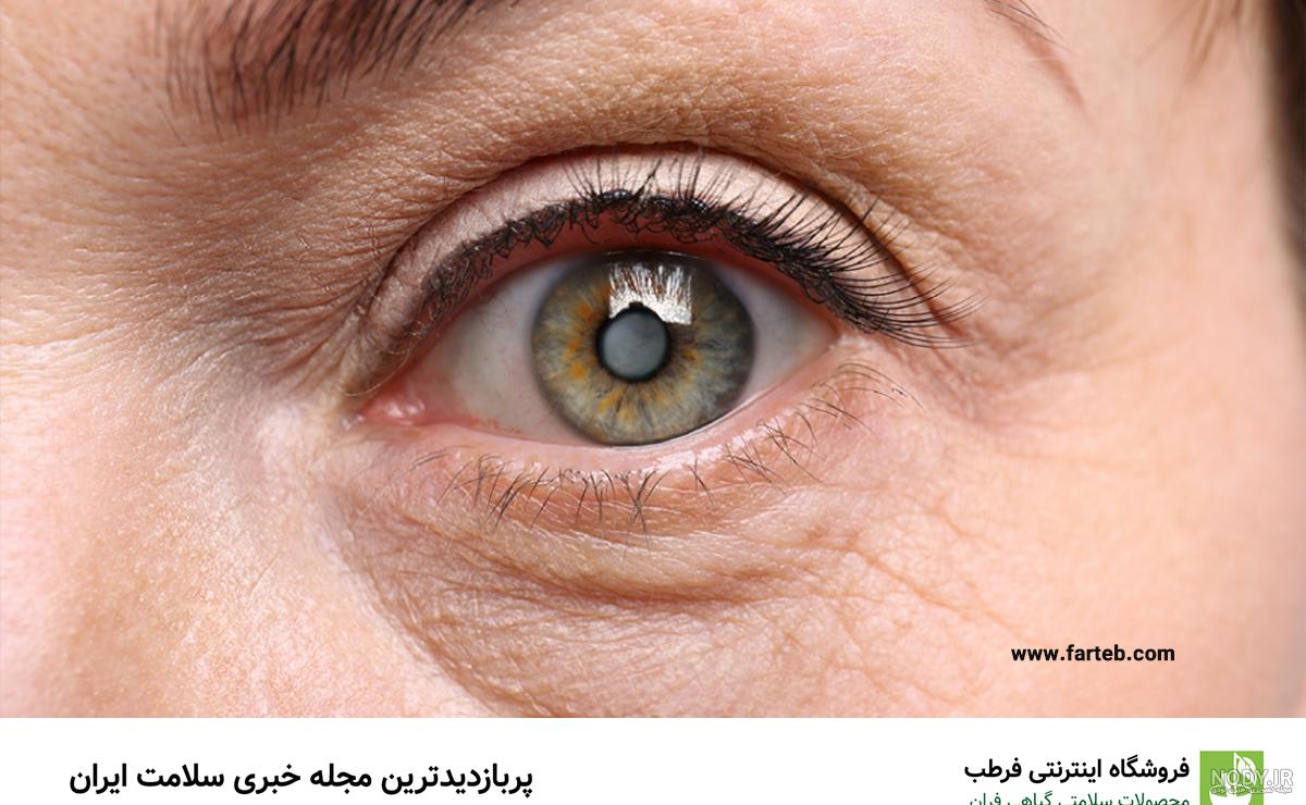 سالانه ۵۰۰ هزار جراحی آب مروارید در ایران انجام می‌شود - ایرنا