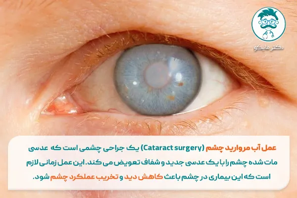علائم ، نشانه و انواع آب مروارید + درمان آب مروارید