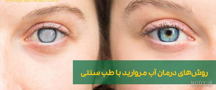 علت بروز آب مروارید چشم چیست؟ | علائم+درمان+پشگیری | به توان