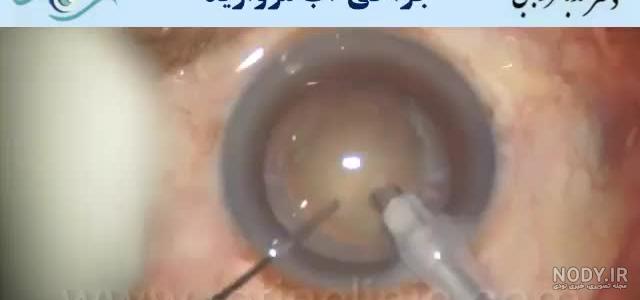 عمل آب مروارید (cataract) - مرکز جراحی چشم ایران عمل آب مروارید (cataract) - مرکز جراحی چشم ایران