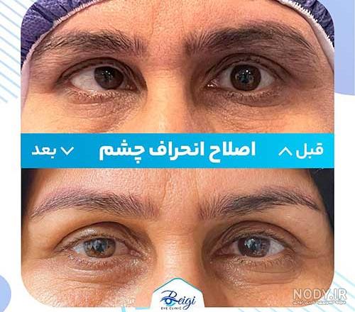 عمل آب مروارید (cataract) - مرکز جراحی چشم ایران