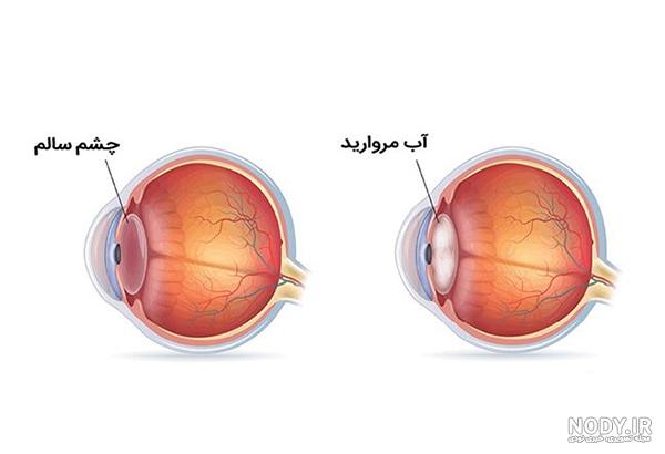 عمل آب مروارید چشم