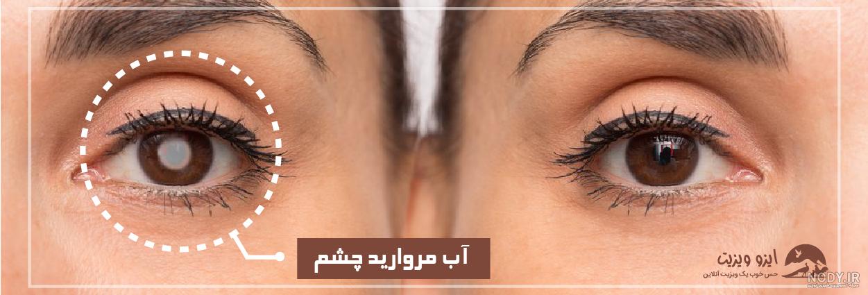 عمل آب مروارید چشم چقدر طول میکشد؟ نقاهت،هزینه و.. دکترمایکو عمل آب مروارید چشم چقدر طول میکشد؟ نقاهت،هزینه و.. دکترمایکو