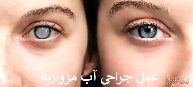 عکس عمل اب مروارید چشم