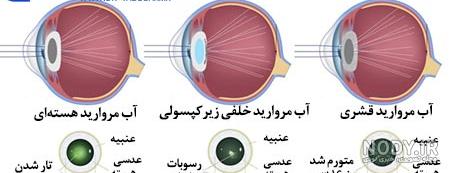 هزینه عمل آب مروارید (کاتاراکت) - چشم پزشکی نوآوران