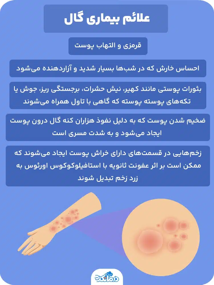 گال چیست و چگونه درمان می‌شود؟ - کیوت اسکین