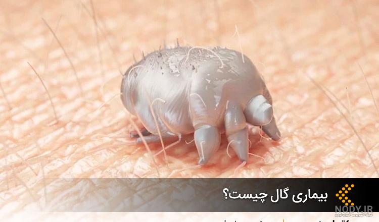 گال در کودکان چیست و چطور درمان می‌شود؟