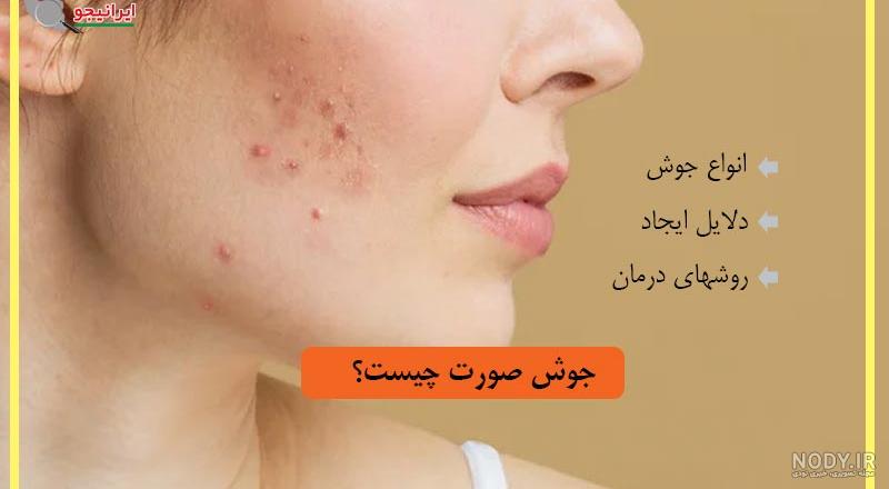 از بین بردن سریع جوش و آکنه | درمان دارویی و خانگی جوش - کلینیک زیبایی دکتر رابط از بین بردن سریع جوش و آکنه | درمان دارویی و خانگی جوش - کلینیک زیبایی دکتر رابط