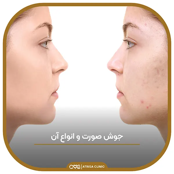 انواع جوش صورت با عکس انواع جوش صورت با عکس