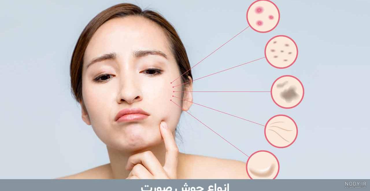 انواع جوش صورت و بدن، علت، تشخیص و درمان 😲! وقت مد انواع جوش صورت و بدن، علت، تشخیص و درمان 😲! وقت مد